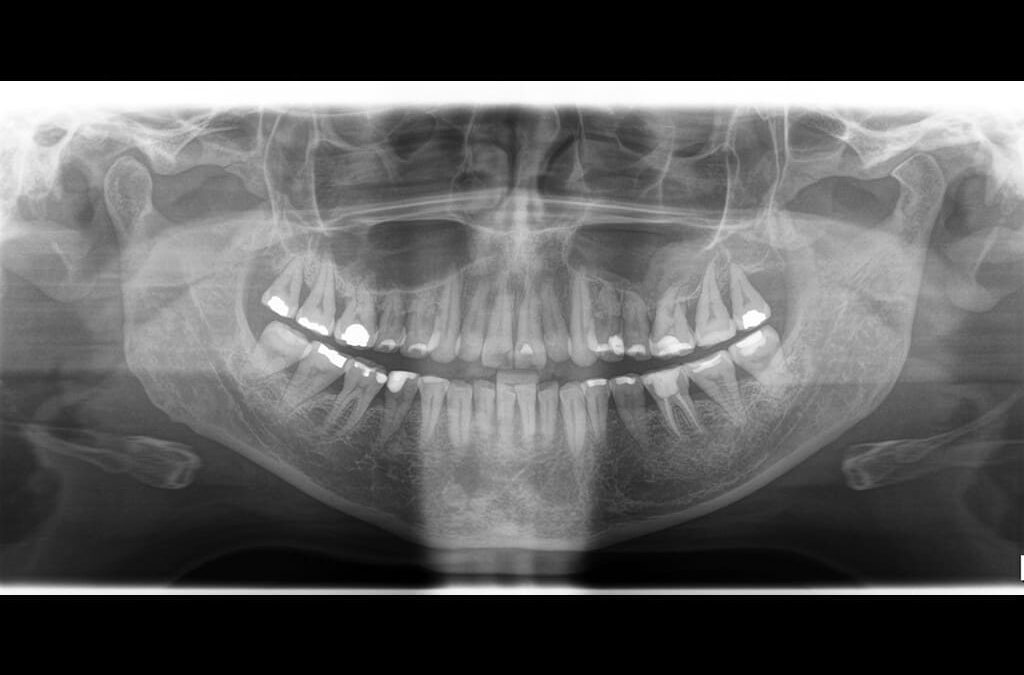 Caso Clínico N°15: Osteofito