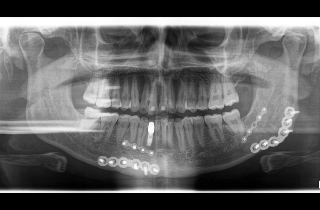 Caso Clínico N° 17: Placas Metálicas-Imagen Fantasma