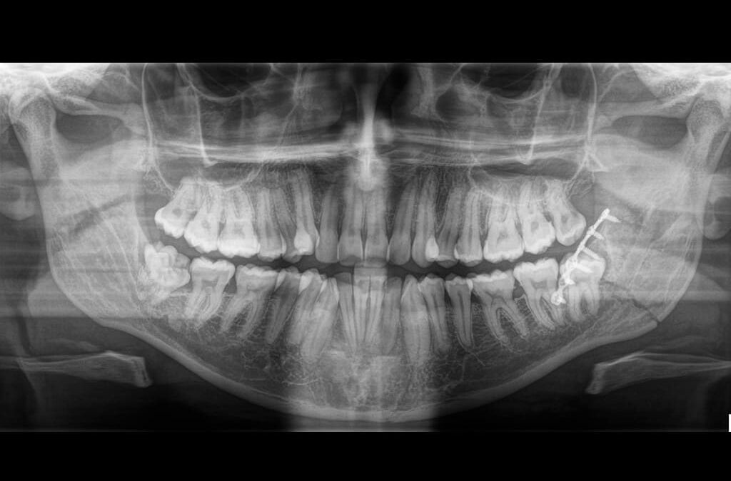 Caso Clínico N° 6: Fractura Mandibular