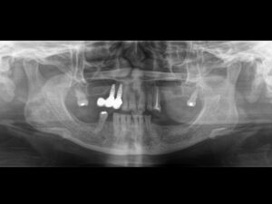 Caso Clínico N°61 - Neumatización del Seno Maxilar - Radiografía Panorámica